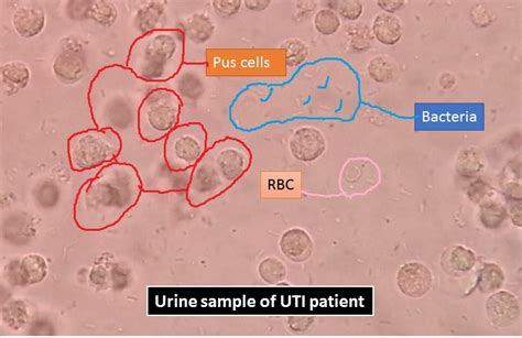 pus cells normal value|Pus Cells in Urine (Pyuria): Symptoms, Causes, Normal Range.